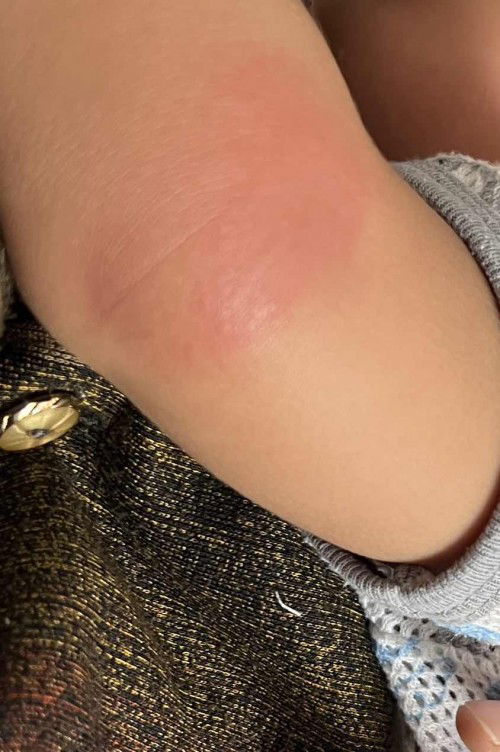 Ruam dan terasa panas