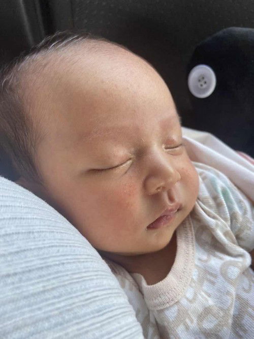 ผดผื่นขึ้นที่หน้าลูก