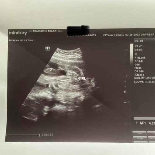 Girl na po ba talaga  mga mi?pa comment naman.CAS pinagawa ko at 24 weeks breech sya.