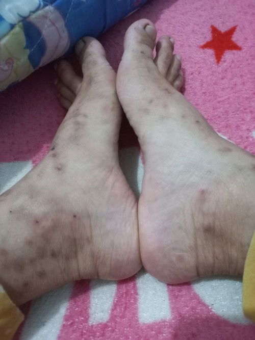 Salep atau hand body penghilang bekas koreng