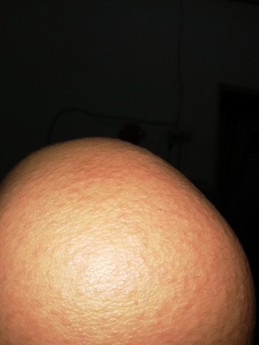 Bun aku hamil pertama di trismester 1, satu badan beruntusan dan gatel", cara ngobatinnya gimana