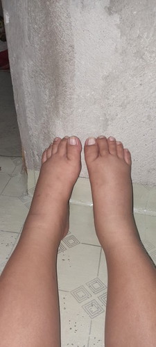 Normal po ba sa 5months preggy ang mamanas ng ganto?1week na pong manas,nagsimula lang nong monday..