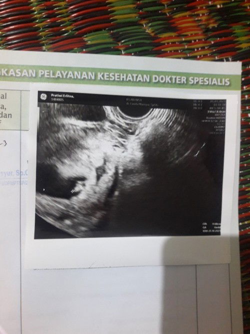 Janin teriindikasi tidak berkembang