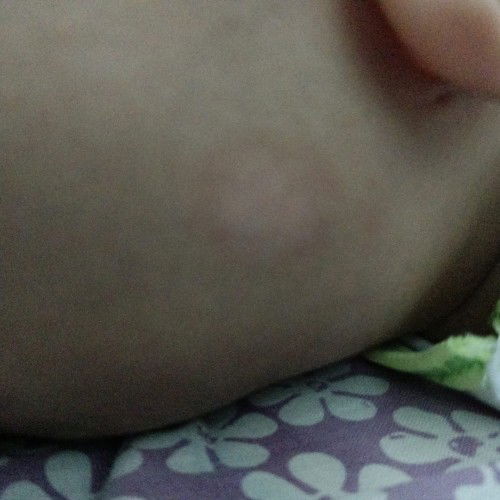 Kaya panu tpi gak tau bner panu apa bkan. Rambutnya jd rontok diarea itu