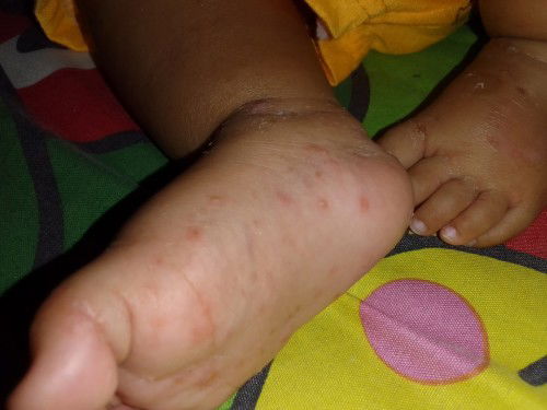 Gatal gatal di tangan dan tubuh bayi