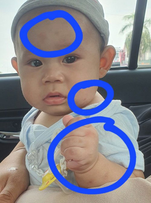 Hai ibu, tolong bagi tips hilangkan parut bekas gigitan nyamuk. Bertompok tompok sudah