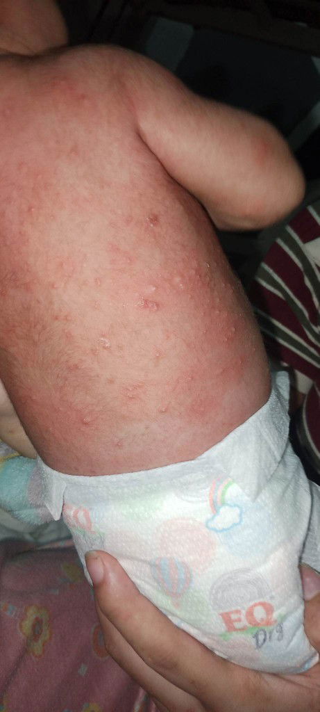 Butlig butlig sa katawan ni baby