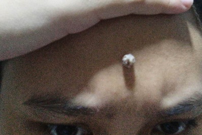 Warts sa Noo