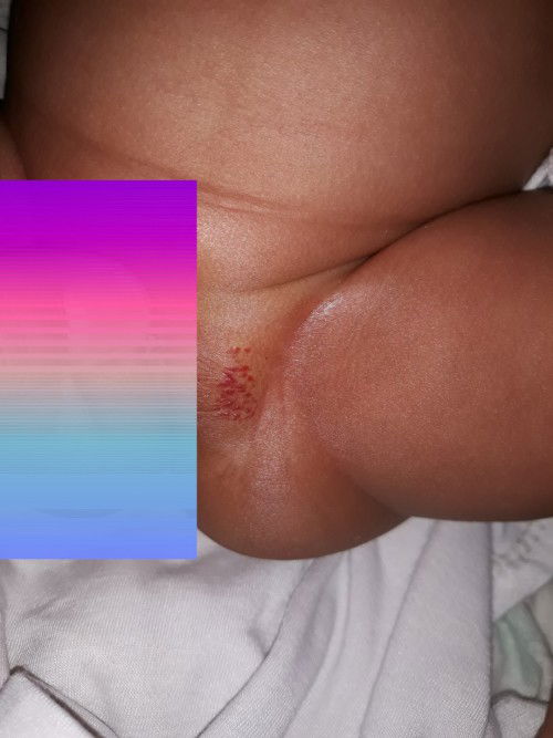 Lecet / ruam 
Bayi 1 bulan