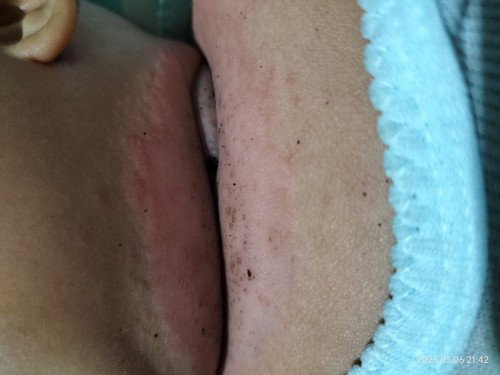 Obat buat gatal2 bayi umur 5bln