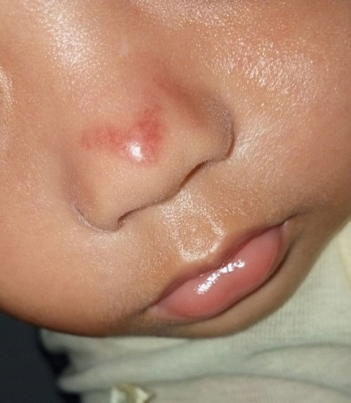 knpa ya bun hidung anak ku merah begini..kira kira karna apa ya?Makin hari makin memerah warna nya
