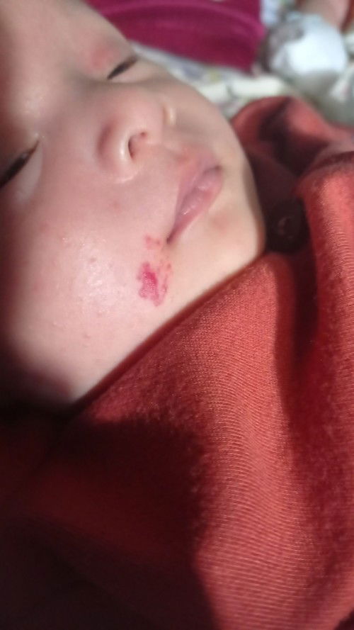 Cara menghilangkan tanda lahir ini