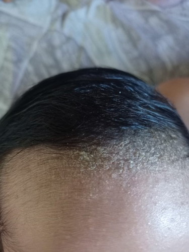 HEAD SCALP