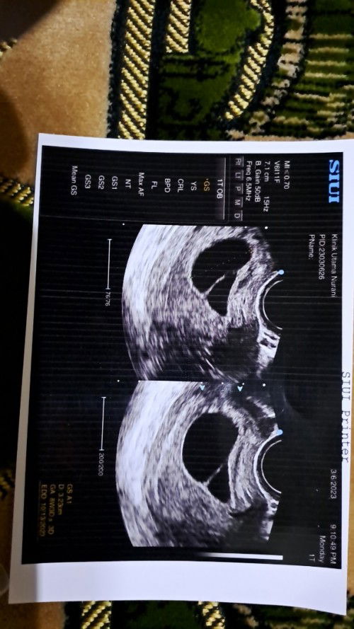 8week belum ada janin, bingung banget bun,sebelumnya udh pernah kuret des kmrn januari positif lagi