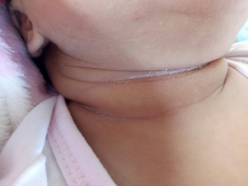 First time mom here! Normal po ba to sa leeg ni baby 1 month lang po siya...