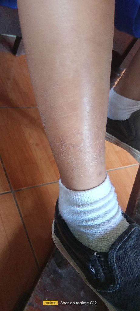 Good morning po mga mommy..
Tanong ko lang po kung sino nakaranas nagkaganti ang balat ng baby nyo?