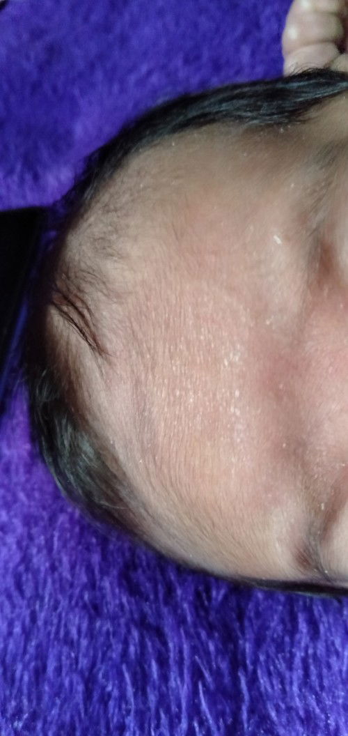 Bun ini bayiku 1 bulan  bakal hilang ga ya? Kaya megar megar gitu tapi ga ilang2 bru kelihatan