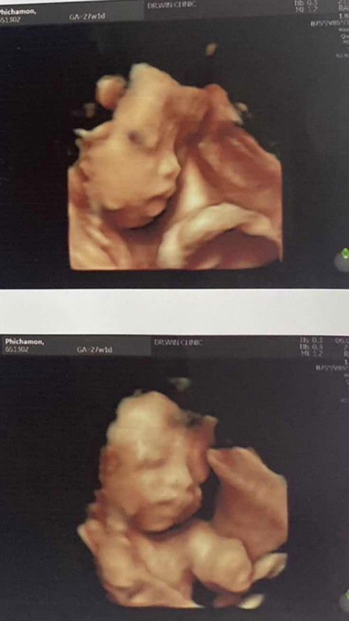 ดั้งน้องจะขึ้นไหมคะ