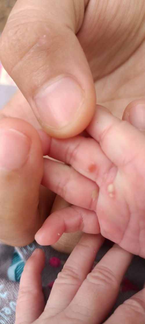 Telapak tangan bintik2