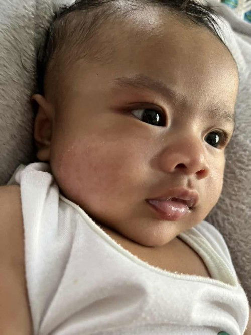 Baby acne (g6pd+)