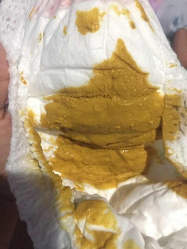 อึแบบนี้ปกติไหม