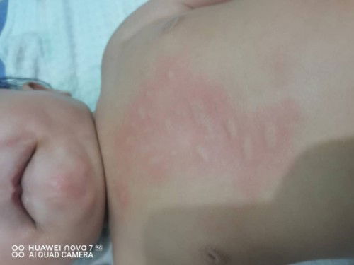 Kulit baby naik kesan bintat