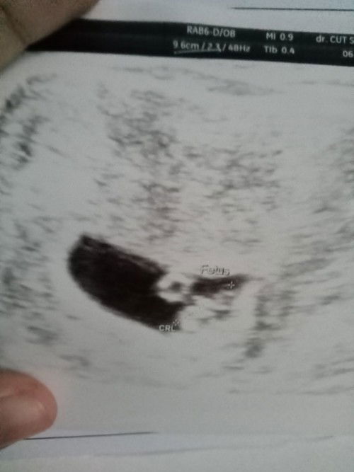 Bund ada yang sama gak ya kantung kehamilan saya tidak bulat