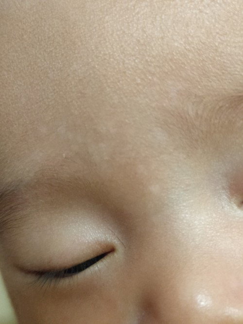 Putih di wajah anak