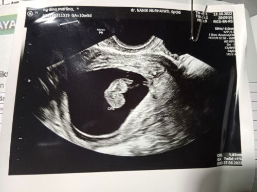 Janin Tidak Berkembang || Sharing yuk bun