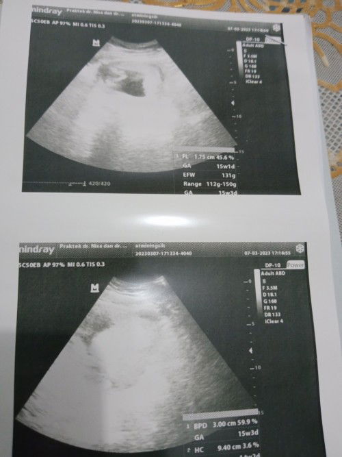 USG tidak bisa denger djj