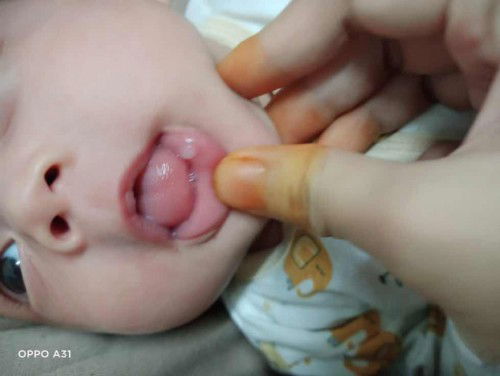 Mata ikan atau ulser?