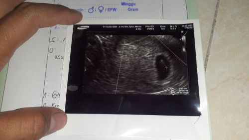 Usg Dan HPHT tidak Sama