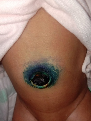 สะดือลูกแฉะมีน้ำเหลืองออกมา