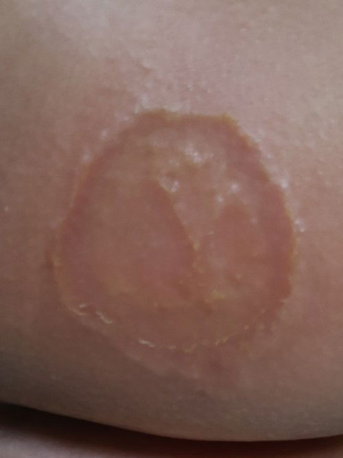 Ruam pampers mcm kurap