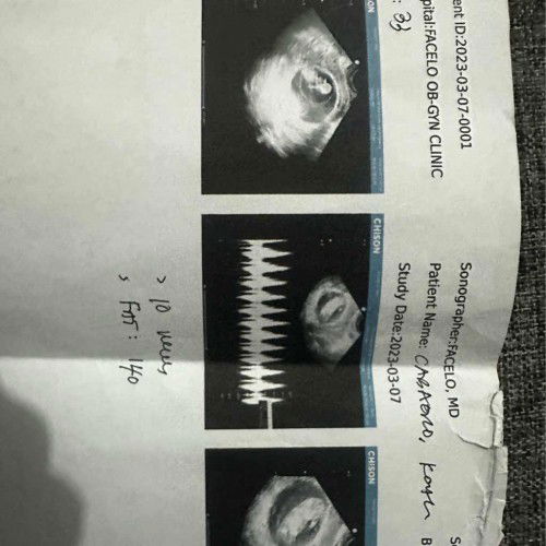 Shifting to bottle feeding