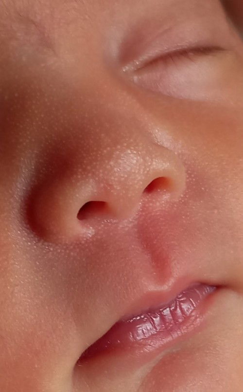 Bintik2 putih dihidung bayi Nb