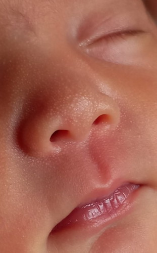 Bintik2 putih dihidung bayi Nb