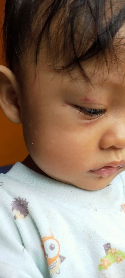 Bintik ruam merah di mata bayi 1 tahun