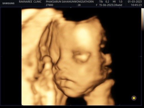 25 week 6 วันลูกน้ำหนักเท่าไหร่กันบ้างคะ