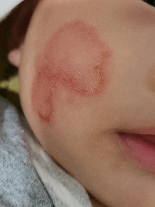 PLEASE. HELP.
anak 4 bulan lebih, minggu lepas tertibe ada rashes ni dekat muka. Dah seminggu :'(