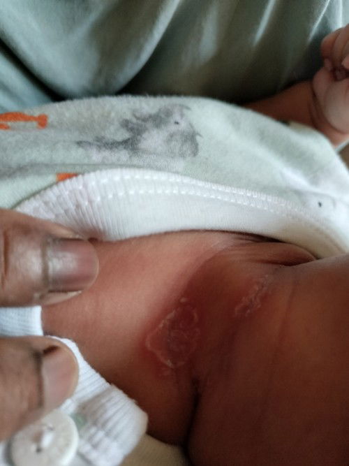 Bun, saya mau tanya kenapa ya di leher anak saya begini.. cara menyembuhkan pake apa ya Bun?