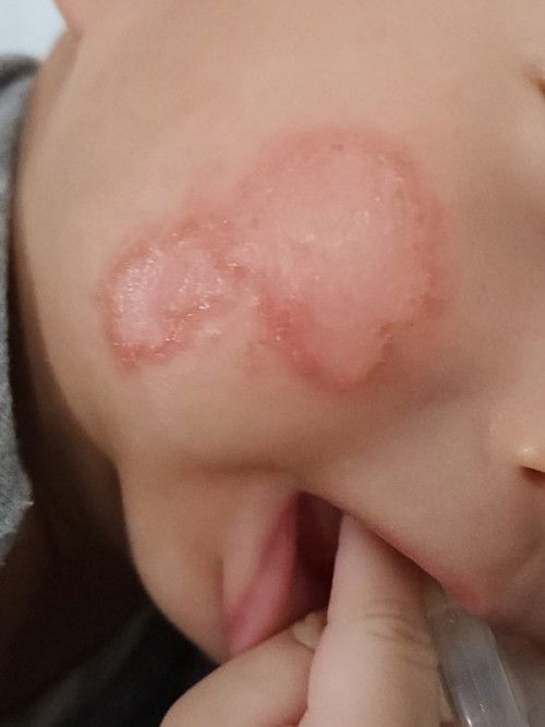 Red patch since a week ago on cheek. Baby is 18 weeks old, exclusive pumping. ANY IDEA WHAT THIS IS?
