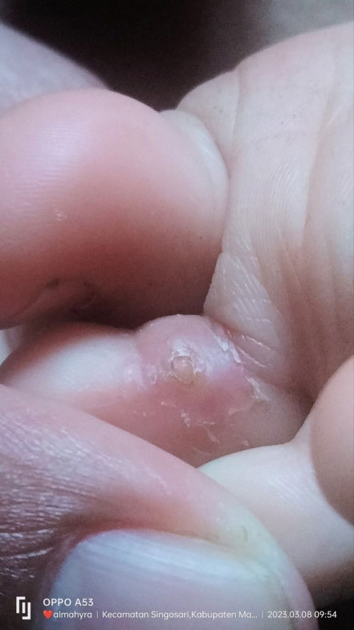 Kaki gatel dan mengelupas