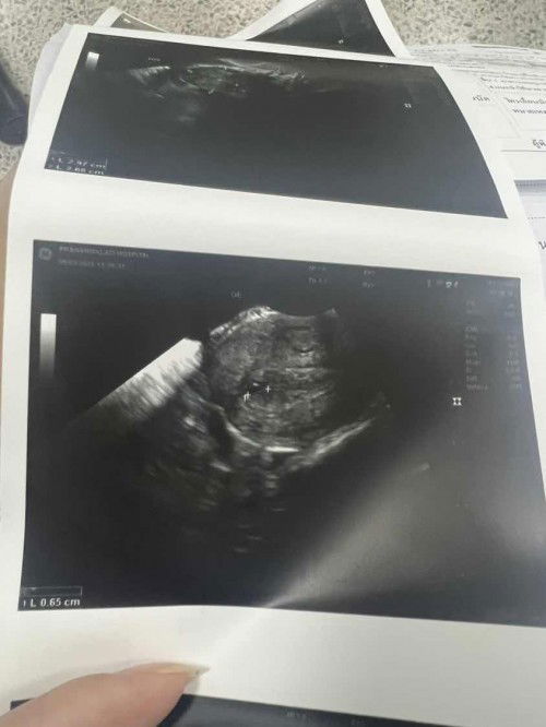 มีเลือดไหล 10 วันตอนนี้เลือดหยุดแล้วค่ะ