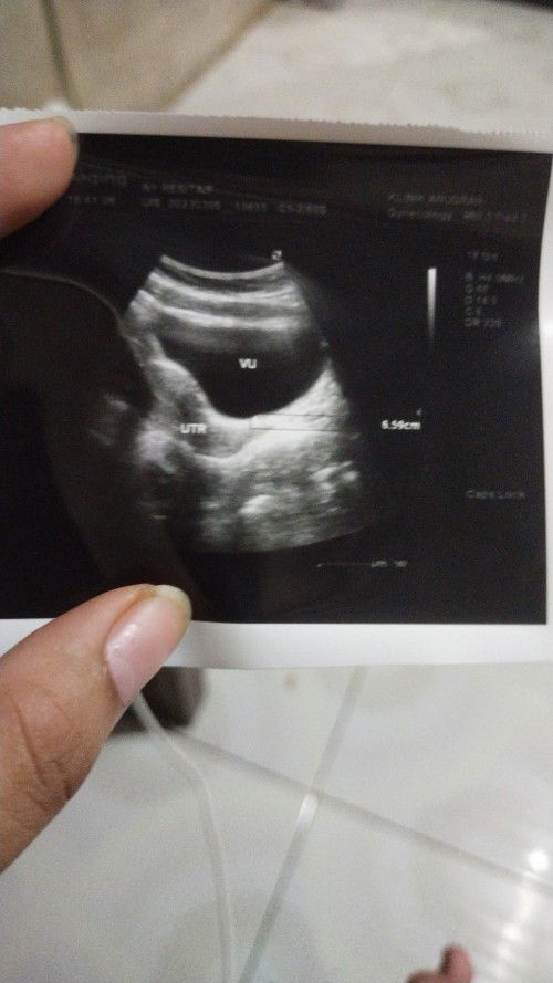 Bun ada yang tau baca hasil USG gk..