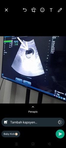 Nampak satu garisan masa scan baby 10 minggu