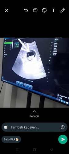 Nampak satu garisan  masa scan baby 10 minggu