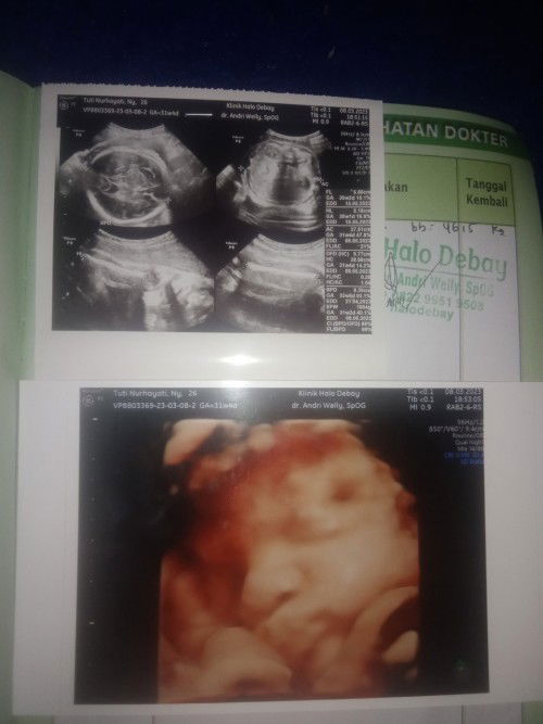 Wajar gak ya Bun BBJ 1804 gram di  usia kehamilan 31w4d?