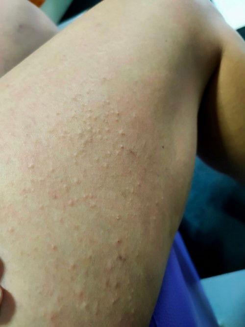 แม่ๆบ้านไหนเป็นผื่นคันแบบในรูปกันบ้างคะ แล้วใช้อะไรทา