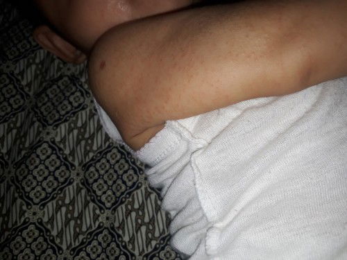 Biang keringat atau alergi?